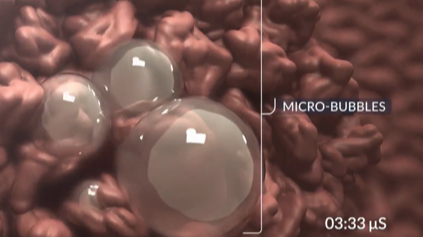 micro-bubbles breaking up a liver tumor